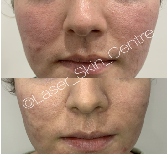 Before and after skin treatment at Laser Skin Centre