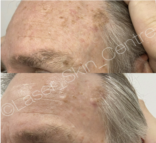 Before and after skin treatment at Laser Skin Centre