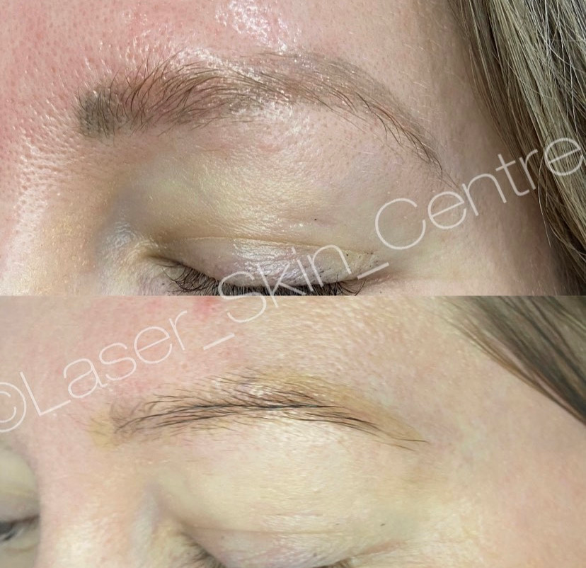 Tattoo removal result before and after Laser Skin Centre