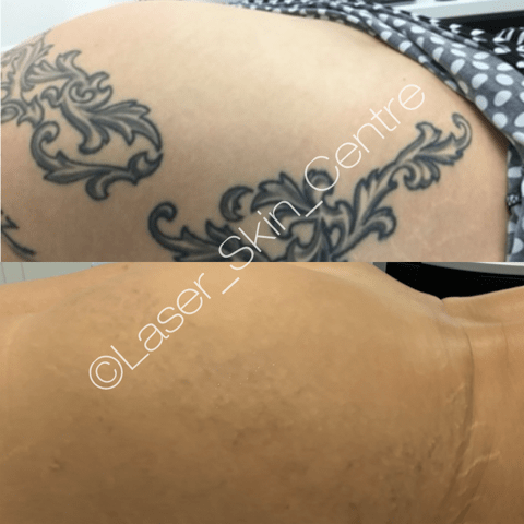 Before and after laser tattoo removal Laser Skin Centre