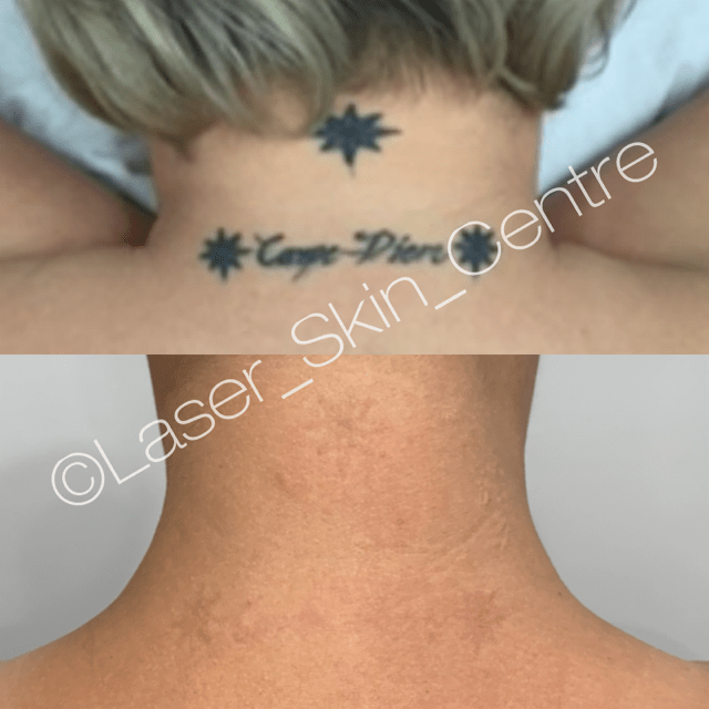 Laser tattoo removal before and after Laser Skin Centre Bilinga QLD