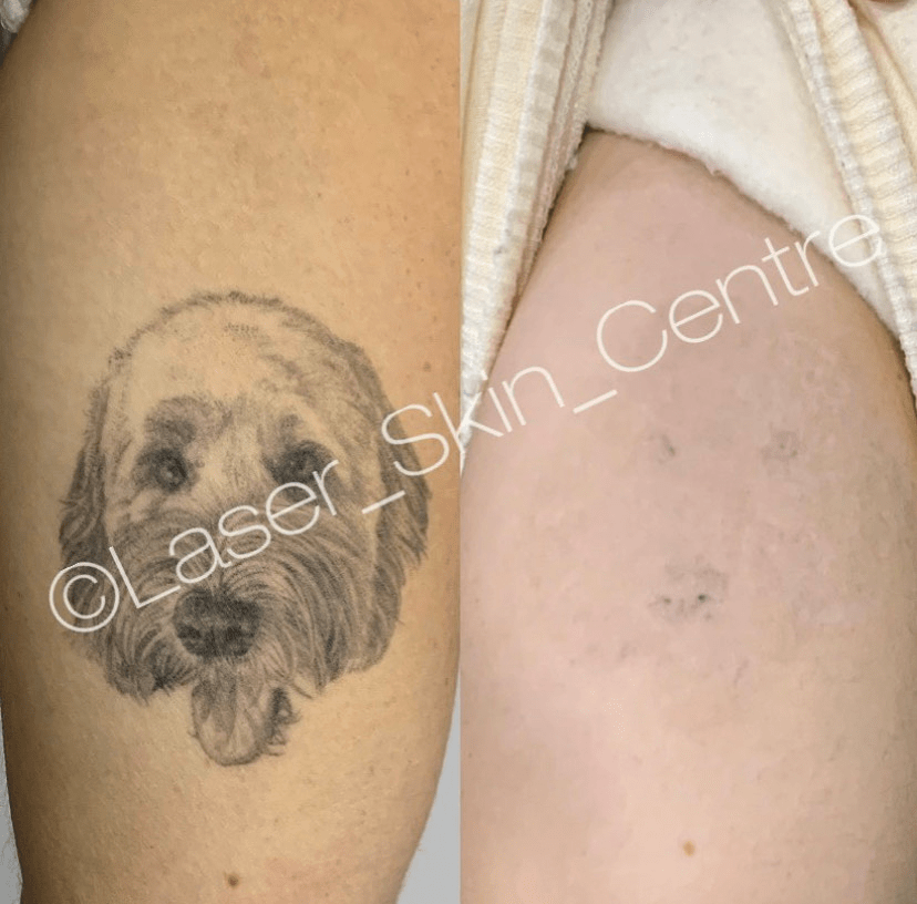 Before and after laser tattoo removal Laser Skin Centre