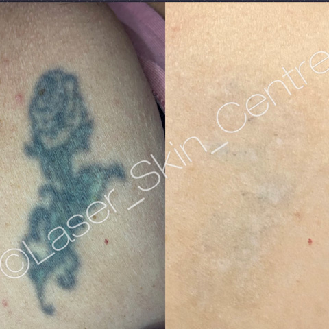 PicoSure tattoo removal result Laser Skin Centre Gold Coast
