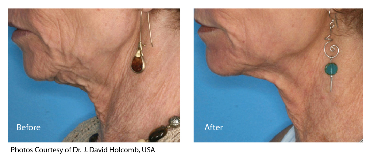 Fractional CO2 full face skin rejuvenation before and after Laser Skin Centre Bilinga QLD