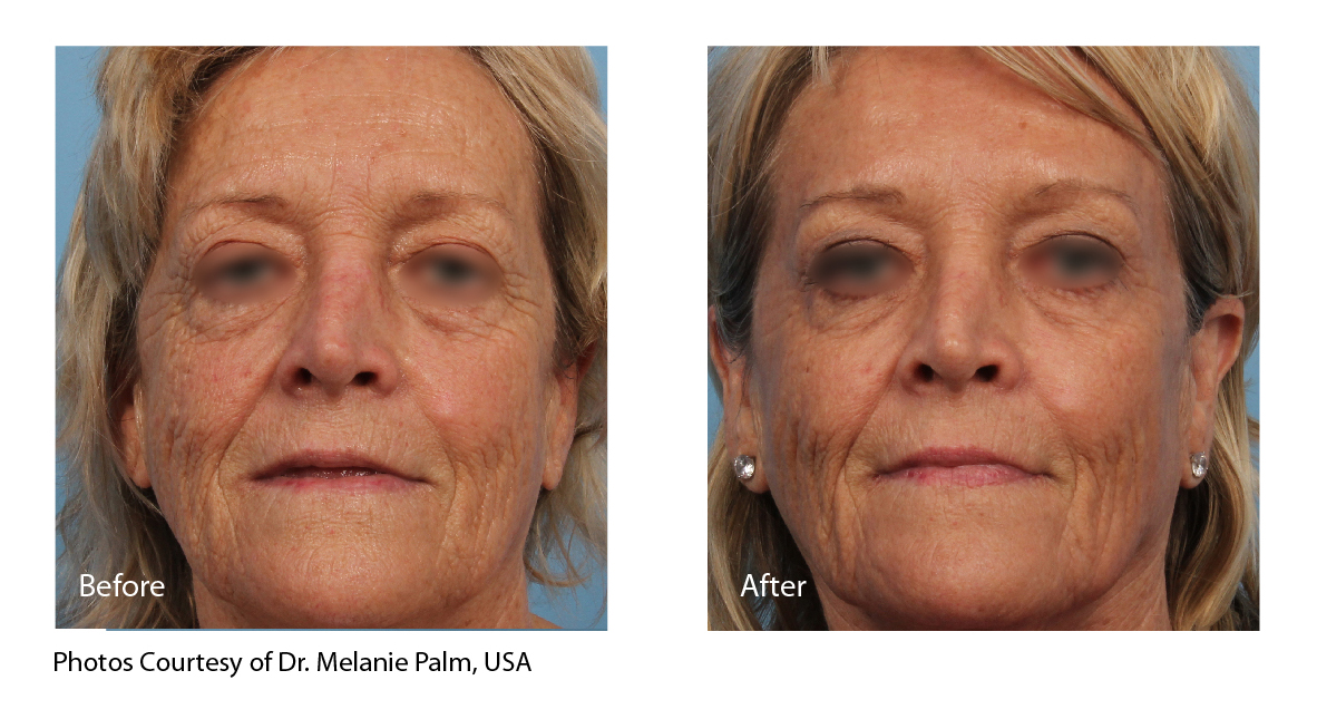 Fractional CO2 laser acne scarring before and after Laser Skin Centre Gold Coast