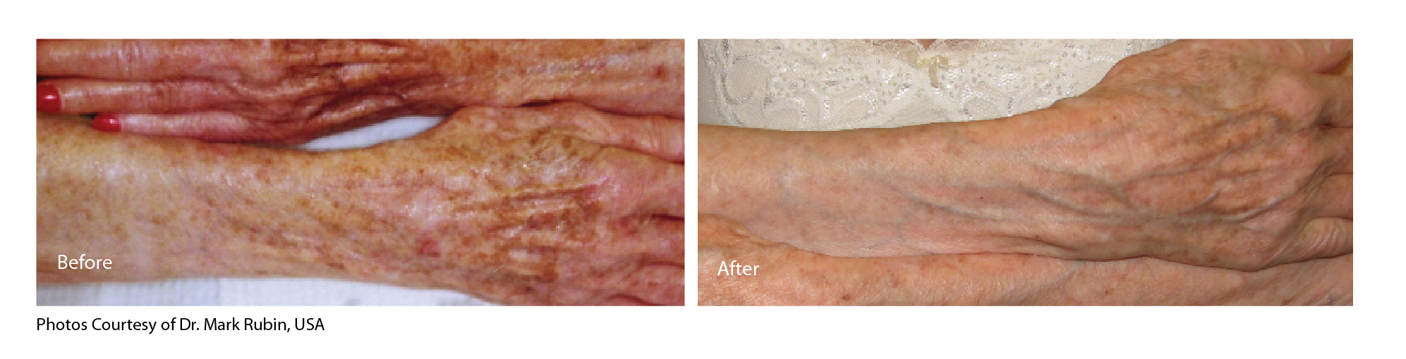Fractional CO2 laser hand pigmentation before and after Laser Skin Centre
