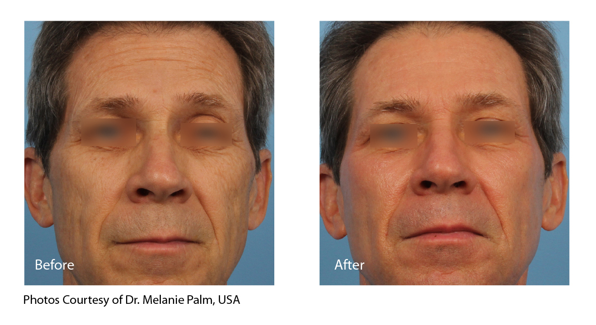 Fractional CO2 laser male full face rejuvenation before and after Laser Skin Centre