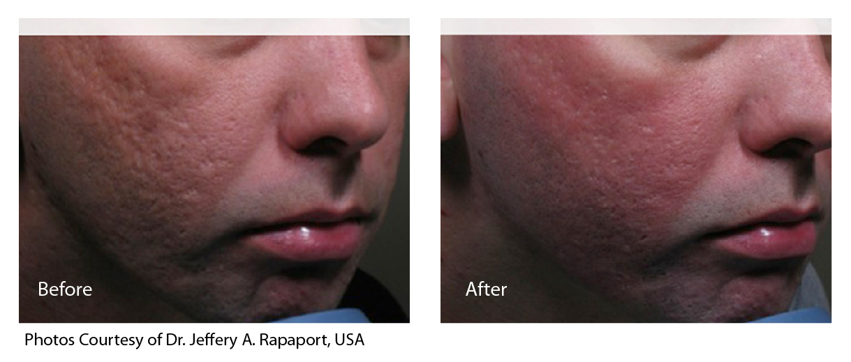 Fractional CO2 laser neck resurfacing before and after Laser Skin Centre