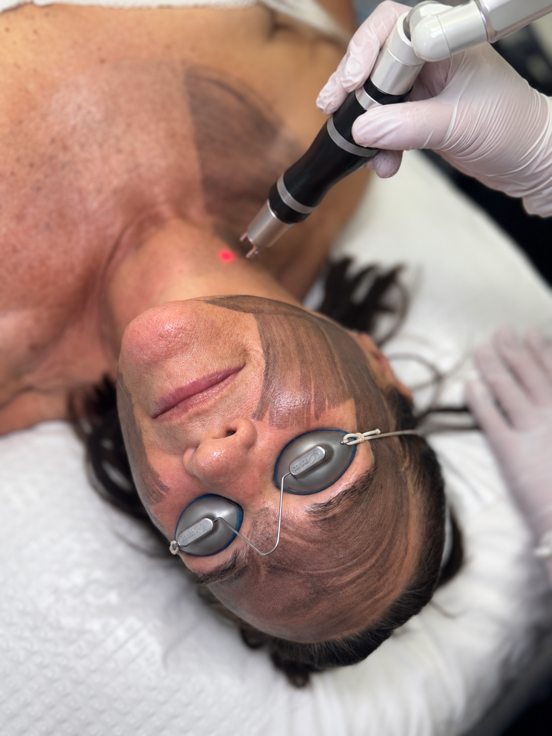 DEKA TORO laser device at Laser Skin Centre Bilinga QLD