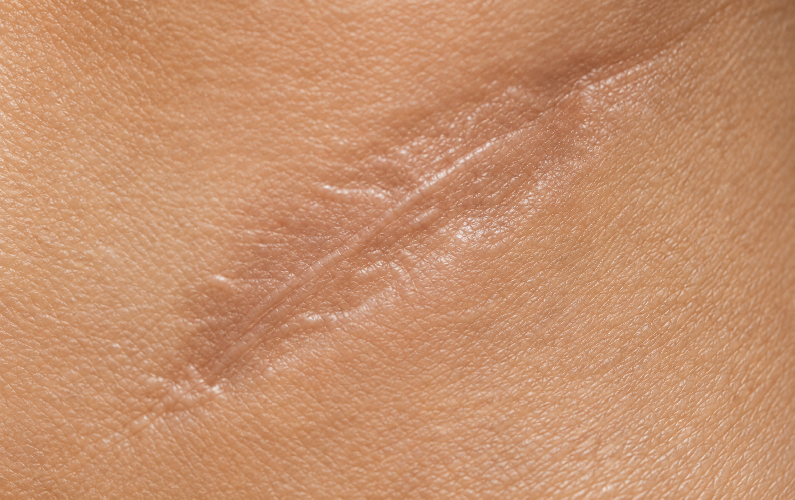 Scar camouflage skin service