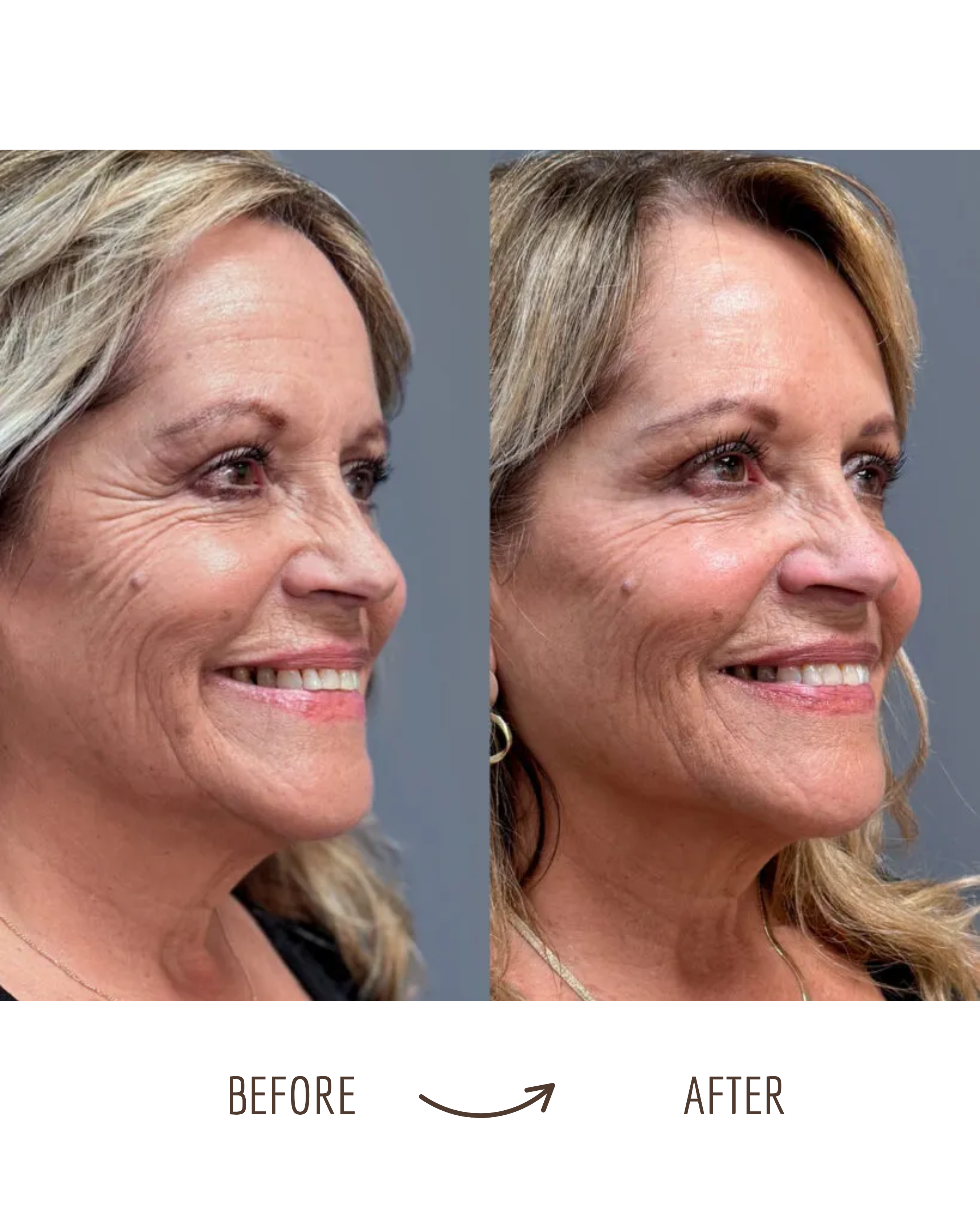 Before and after full-face refresh