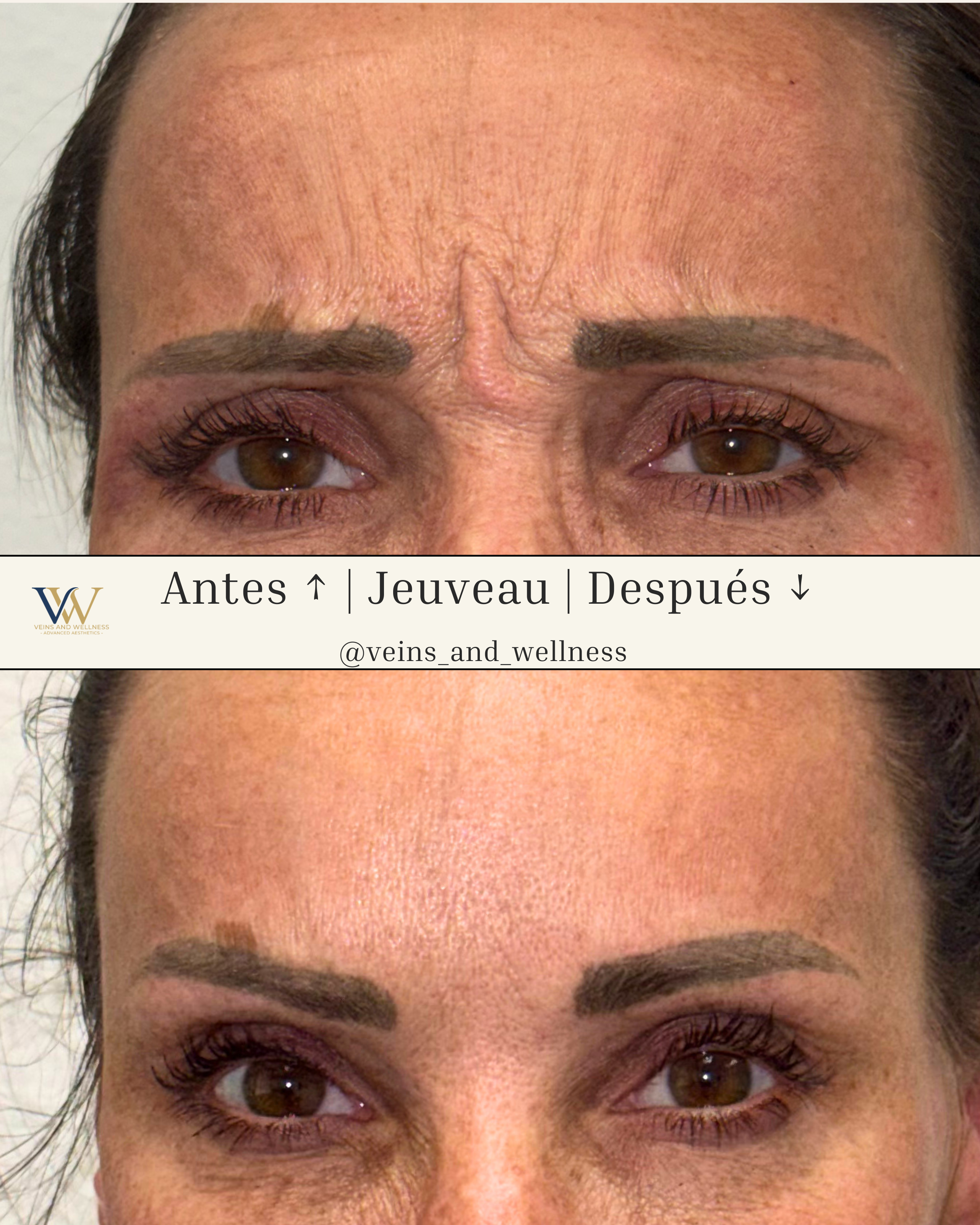 Before and after frown lines