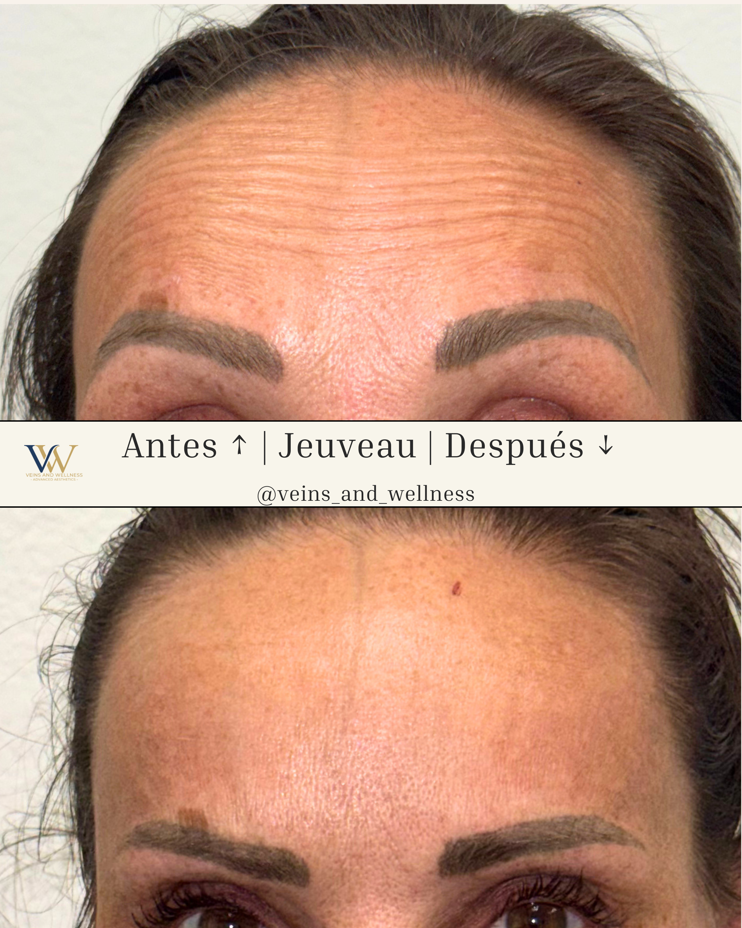 Before and after forehead and brow