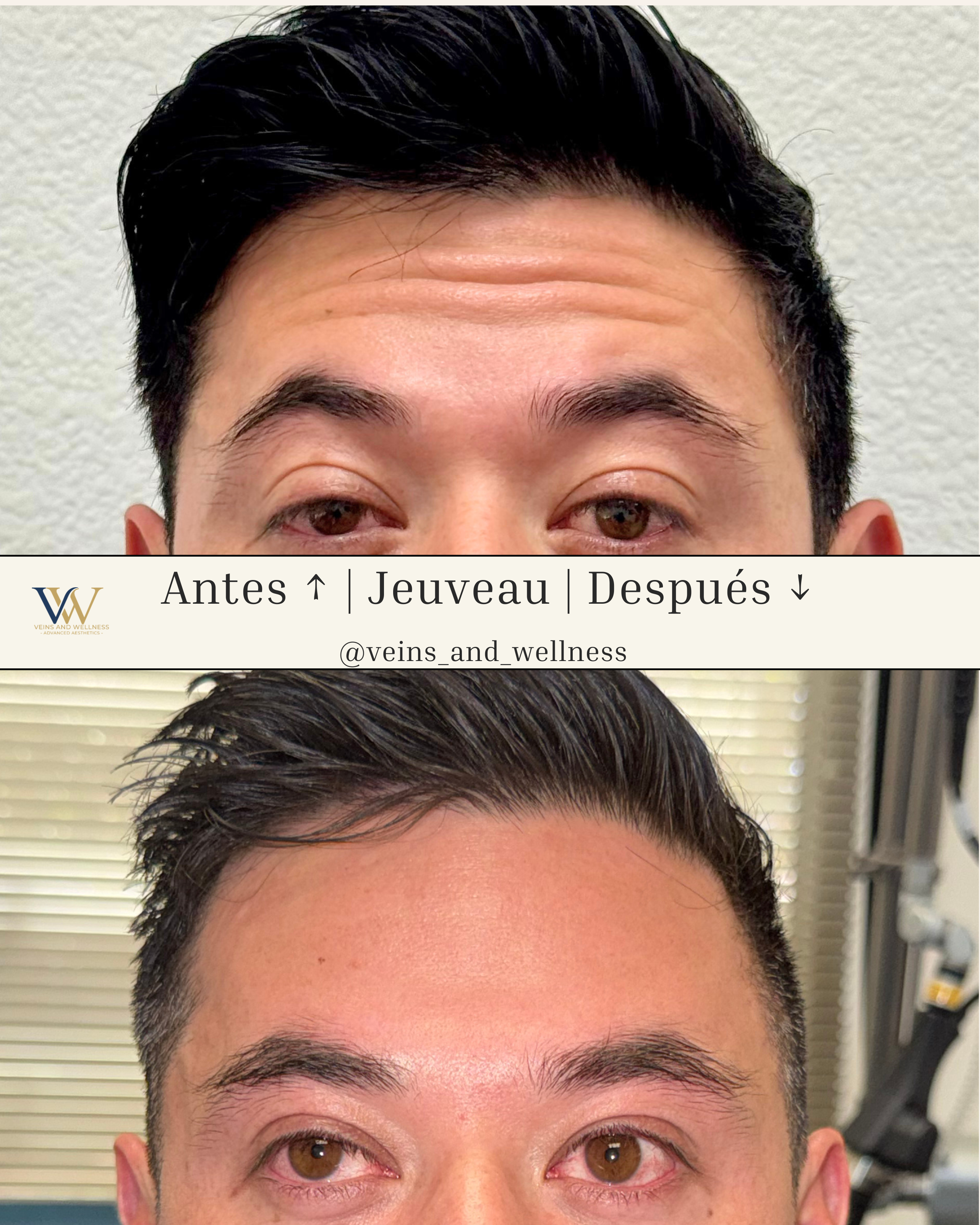 Before and after forehead lines