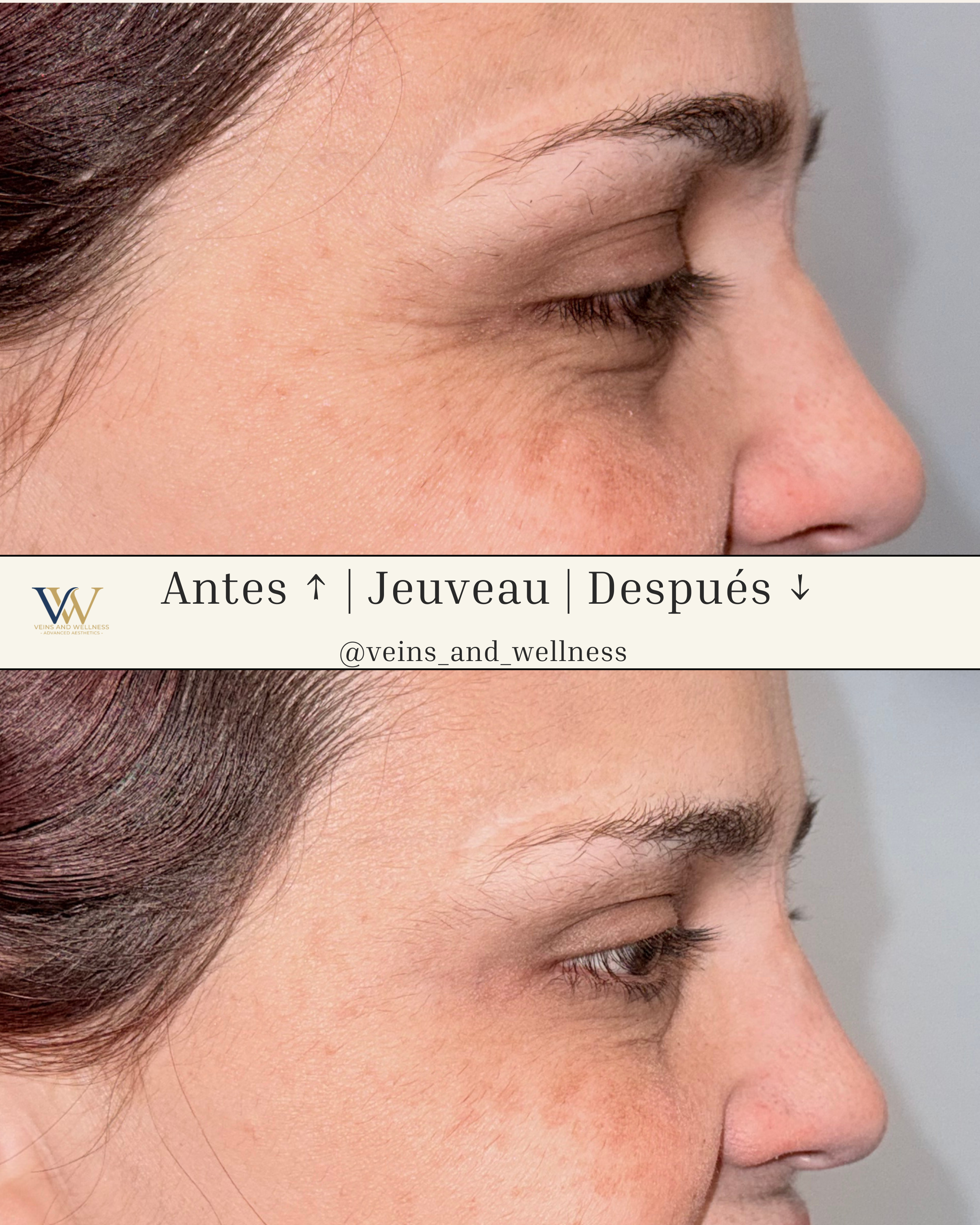 Before and after crow's feet