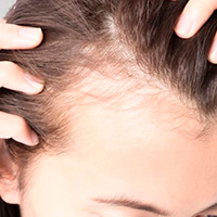 Tratamento de Queda de Cabelo