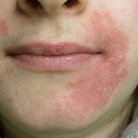 Tratamento de Dermatite