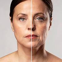 Tratamento de Lifiting Facial