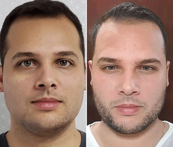Antes e Depois da Harmonização facial