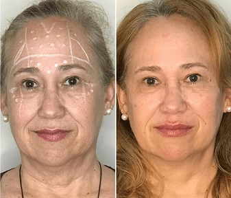 Antes e Depois da Harmonização facial