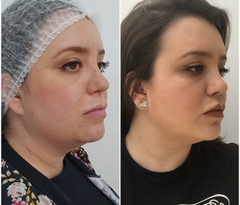 Antes e Depois da Harmonização facial