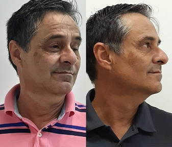 Antes e Depois da Harmonização facial