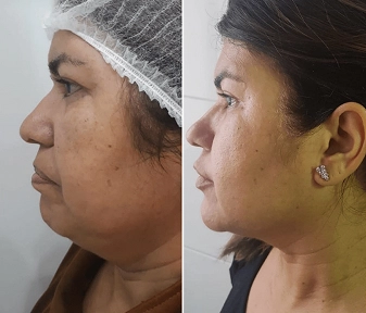 Antes e Depois da Harmonização facial