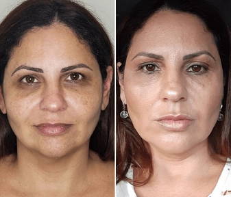 Antes e Depois da Harmonização facial