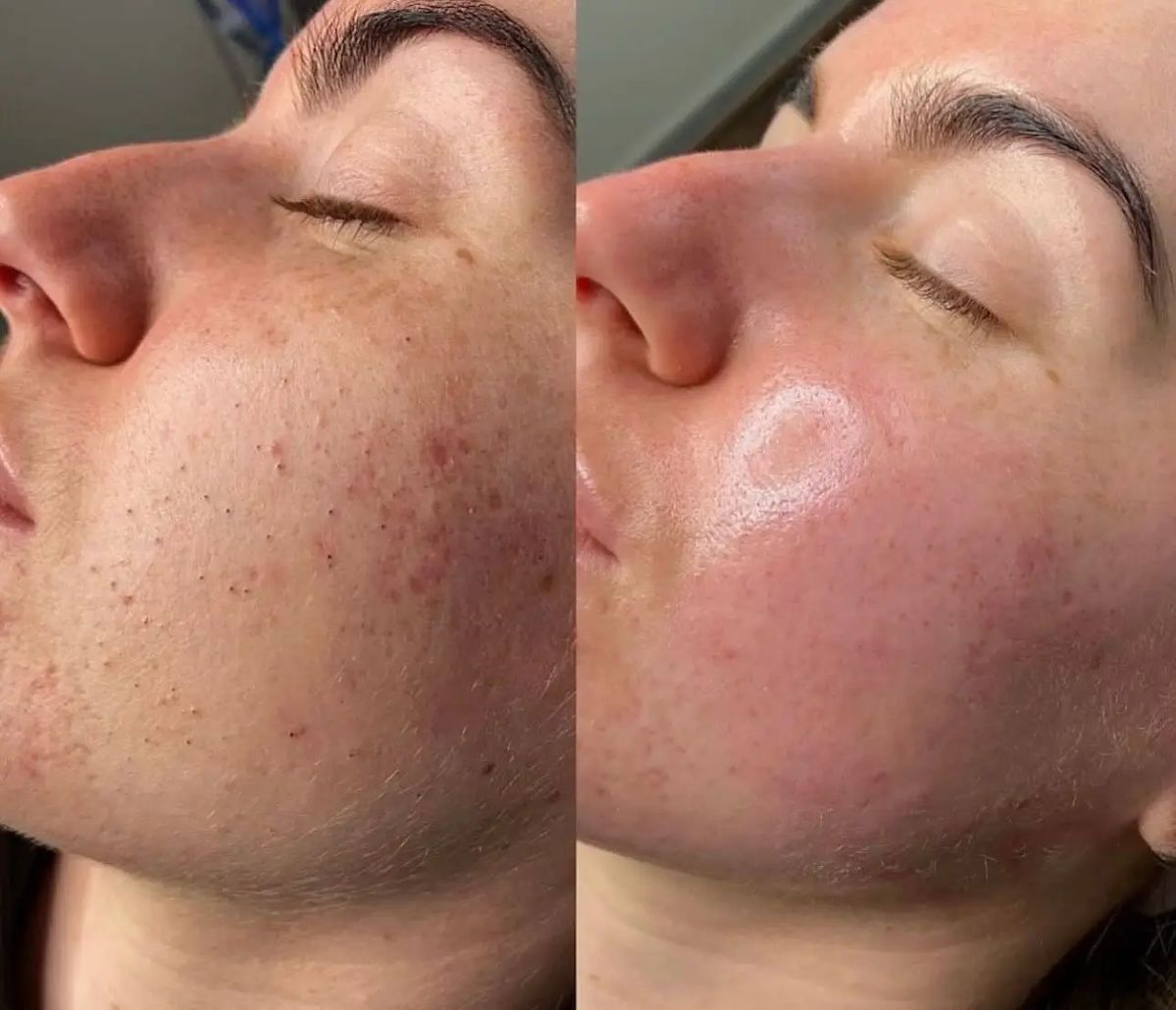 Resultado antes y después en beauté
