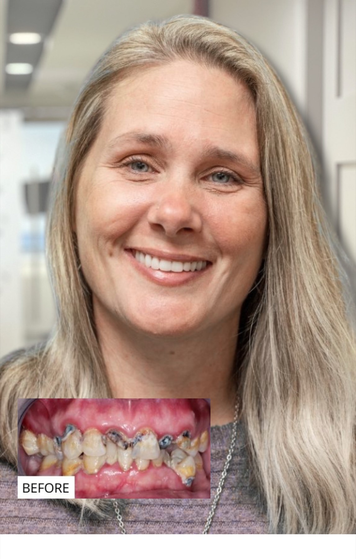 Mandy, a full-arch patient, smiling — with her before photo inset.