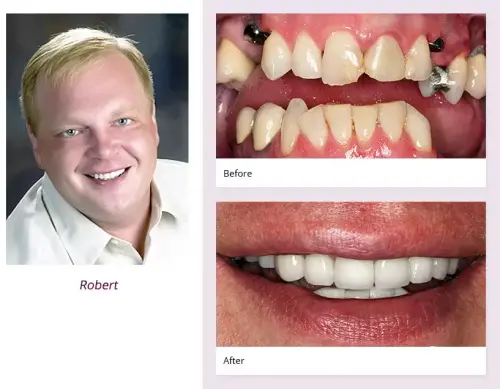 Before and After dental implants result 1