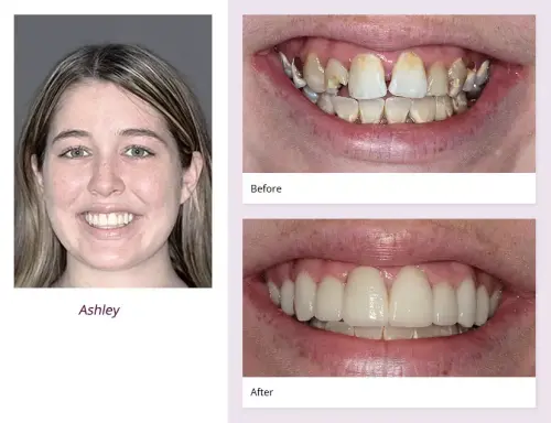 Before and After dental implants result 3