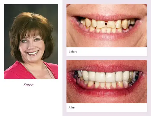 Before and After dental implants result 2