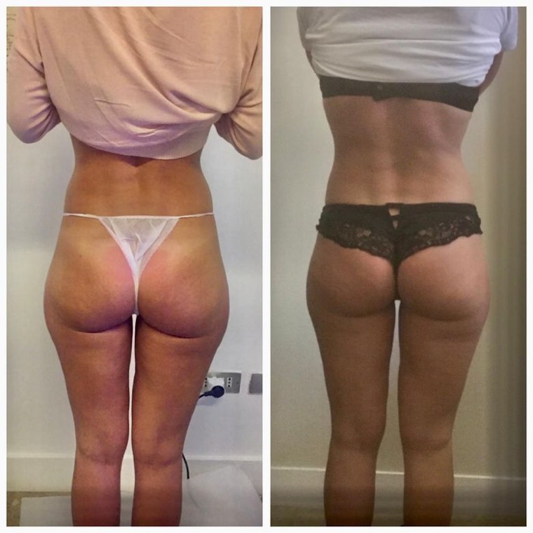 Prima e dopo, silhouette