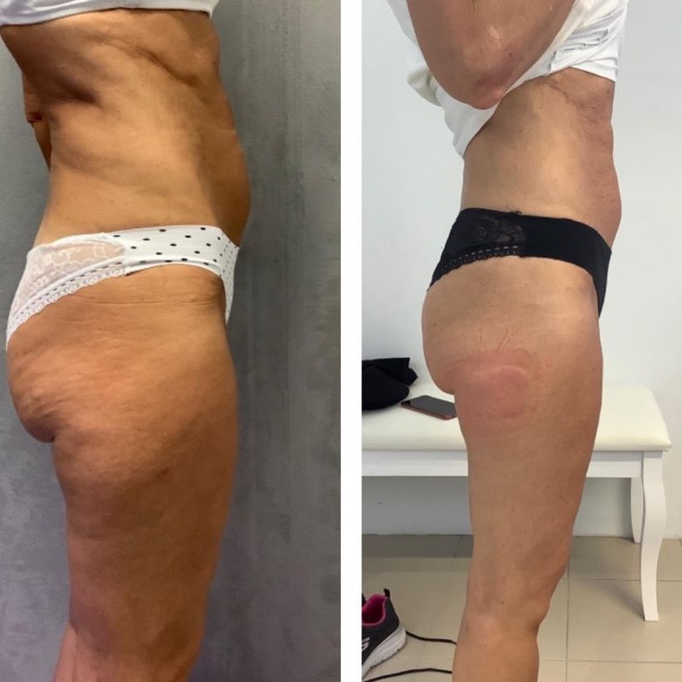 Prima e dopo, addome di profilo