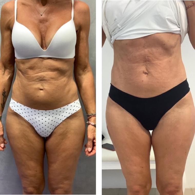 Prima e dopo, gambe