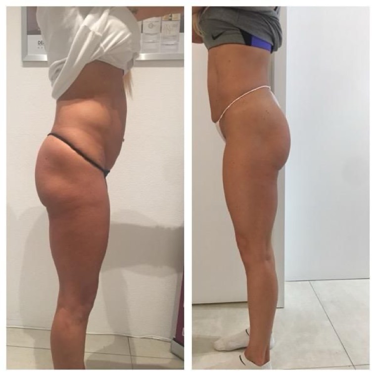 Prima e dopo, fianchi