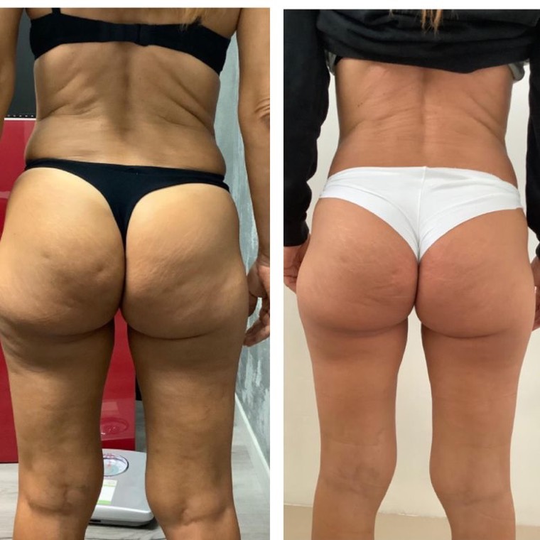 Prima e dopo, girovita