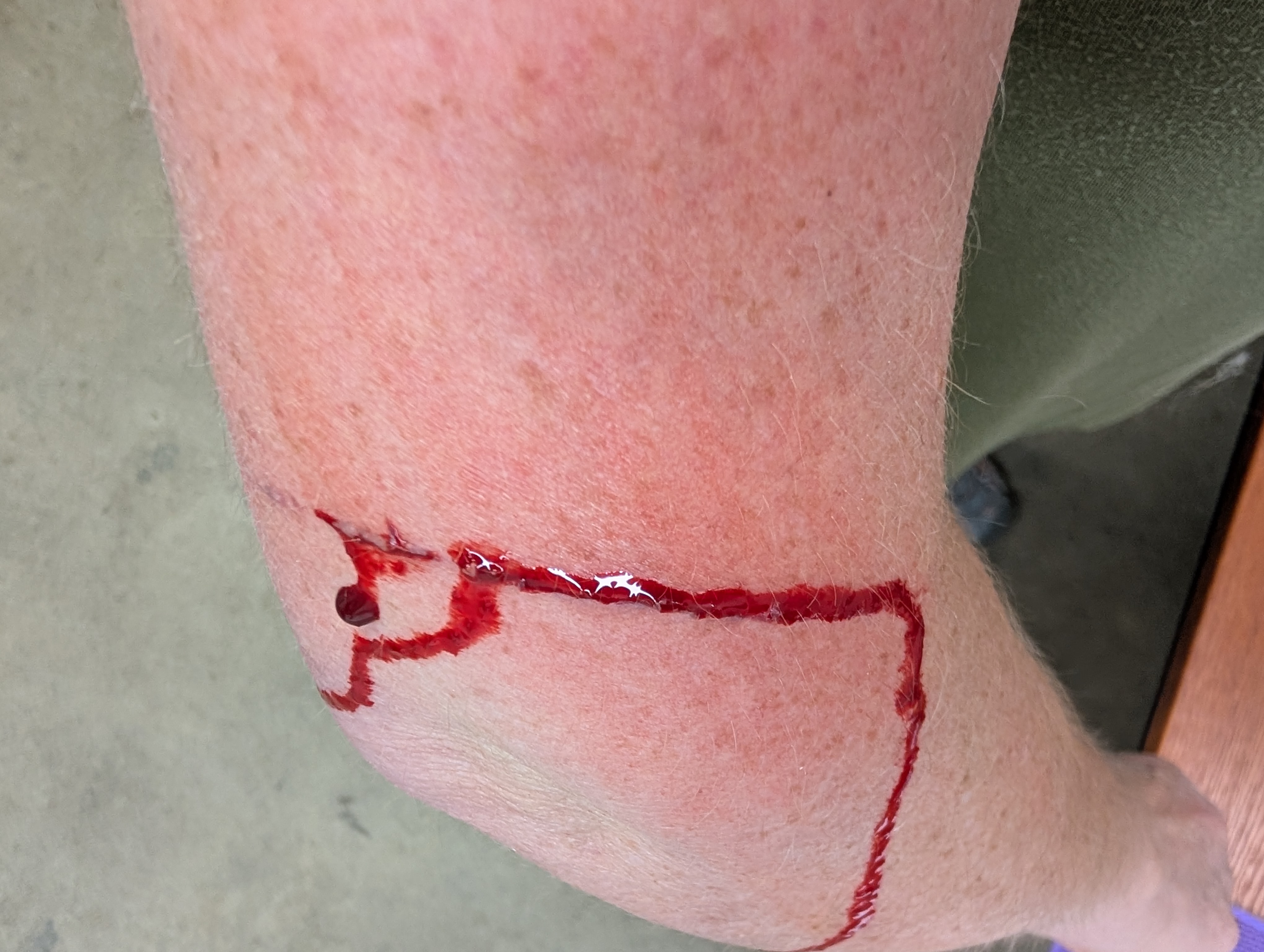 a small trickle of blood runs down an arm