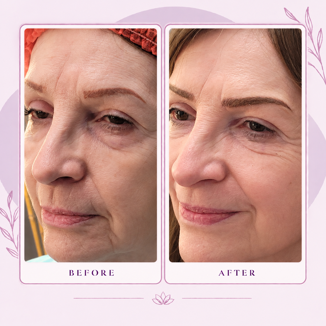 Close-up of a client's eye, brow, and face showing healed color correction result