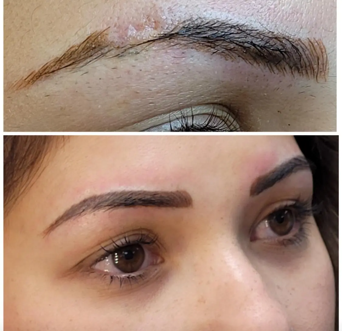 Before-and-after showing scar-affected eyebrow restoration