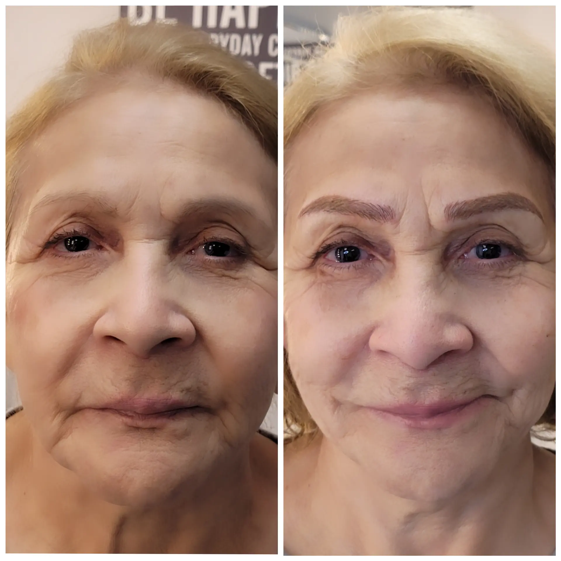 Mature woman with complex brow concerns including sparse hair and asymmetry, suited for individualized corrective planning