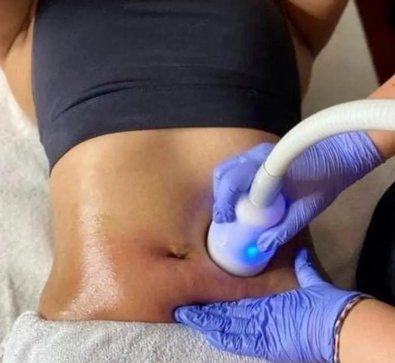 Cryo T-Shock + Zerona Cold Laser single session body contouring