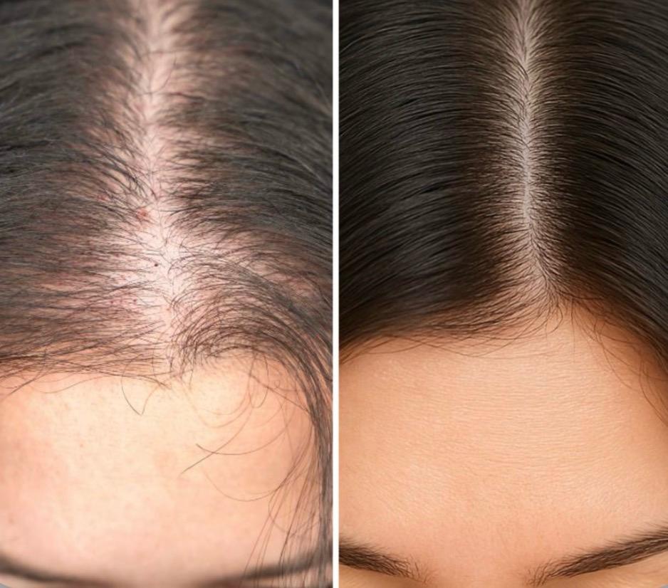 Scalp microchanneling hair restoration treatment