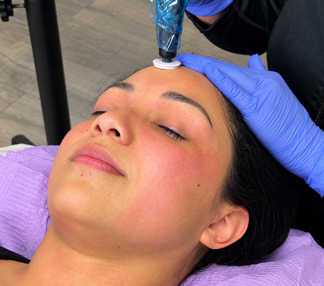 Microchanneling treatment result after 3 sessions
