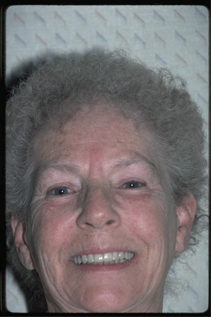 Before phenol peel