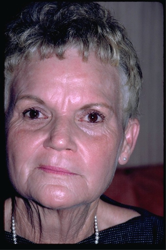 After phenol peel