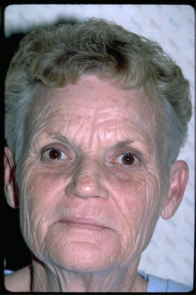 Before phenol peel