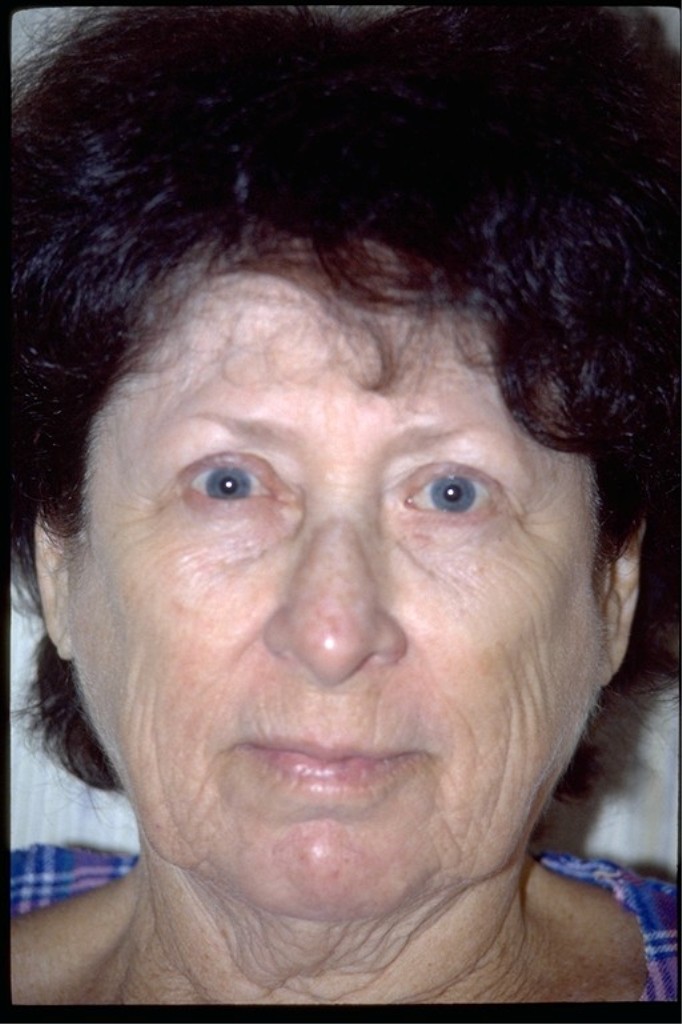 Before phenol peel