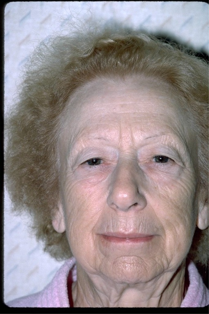 Before phenol peel